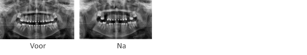 Voor en na röntgenfoto's van het verplaatsen van een tand of kies